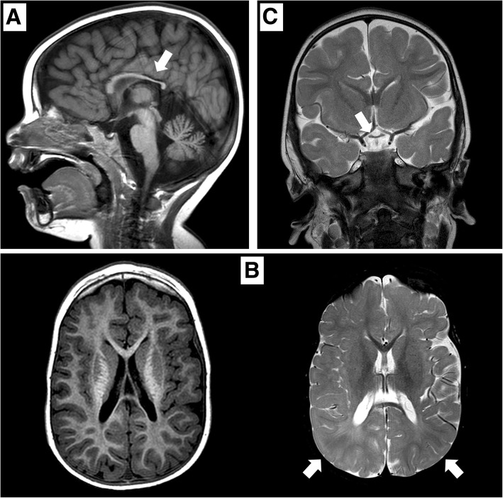 【佳学基因检测】德莫塞尔综合征分子诊断怎么做De Morsier syndrome? 【佳学基因检测】德莫塞尔综合征分子诊断怎么做De Morsier syndrome?