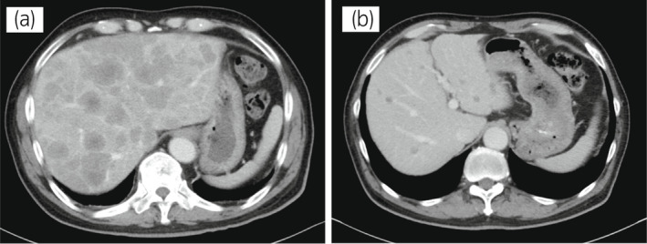 【佳学基因检测】靶向药物奥拉帕尼治疗具有BRCA突变的前列腺癌患者