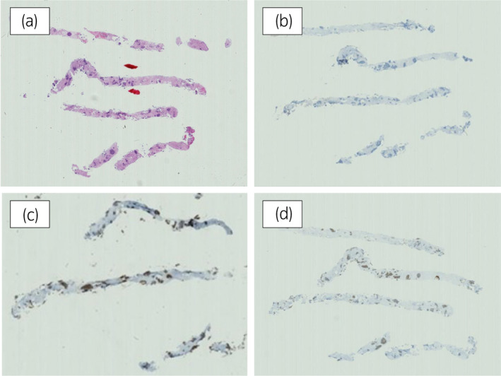 【佳学基因检测】靶向药物奥拉帕尼治疗具有BRCA突变的前列腺癌患者