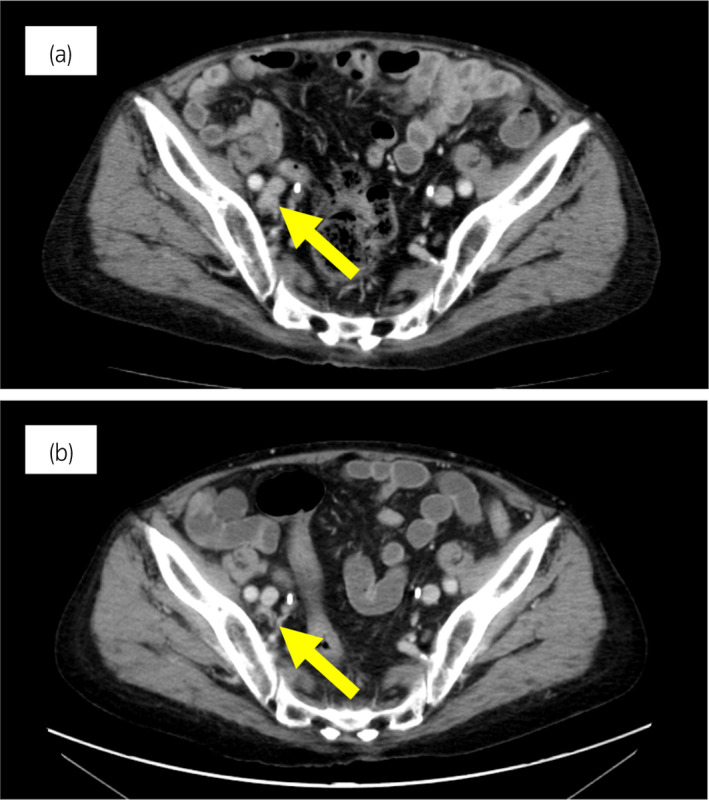 【佳学基因检测】靶向药物奥拉帕尼治疗具有BRCA突变的前列腺癌患者