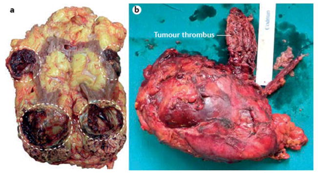 【佳学基因检测】肾脏癌靶向药物基因检测(Kidney Cancer) 【佳学基因检测】肾脏癌靶向药物基因检测(Kidney Cancer)