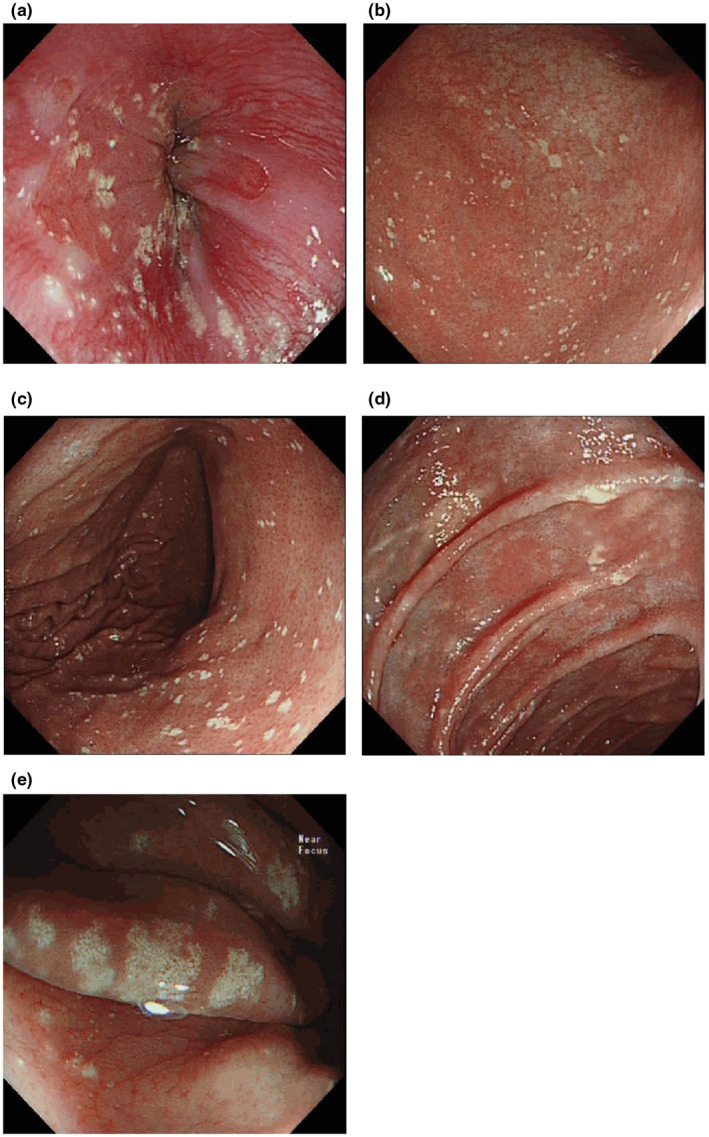 【佳学基因检测】CHILD综合征基因解码、基因检测有什么用? 【佳学基因检测】CHILD综合征基因解码、基因检测有什么用?