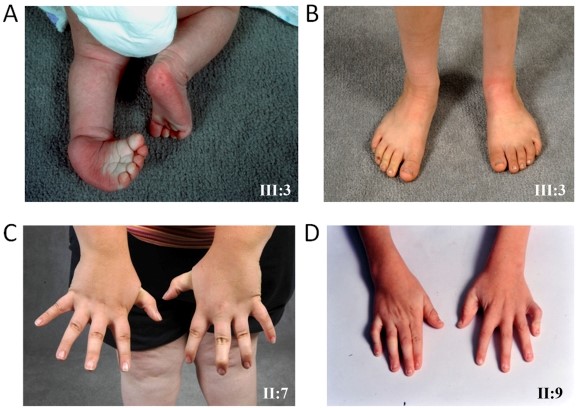 【佳学基因检测】采用外显子测序基因检测明确关节弯曲是一种AMCD1遗传病 【佳学基因检测】采用外显子测序基因检测明确关节弯曲是一种AMCD1遗传病