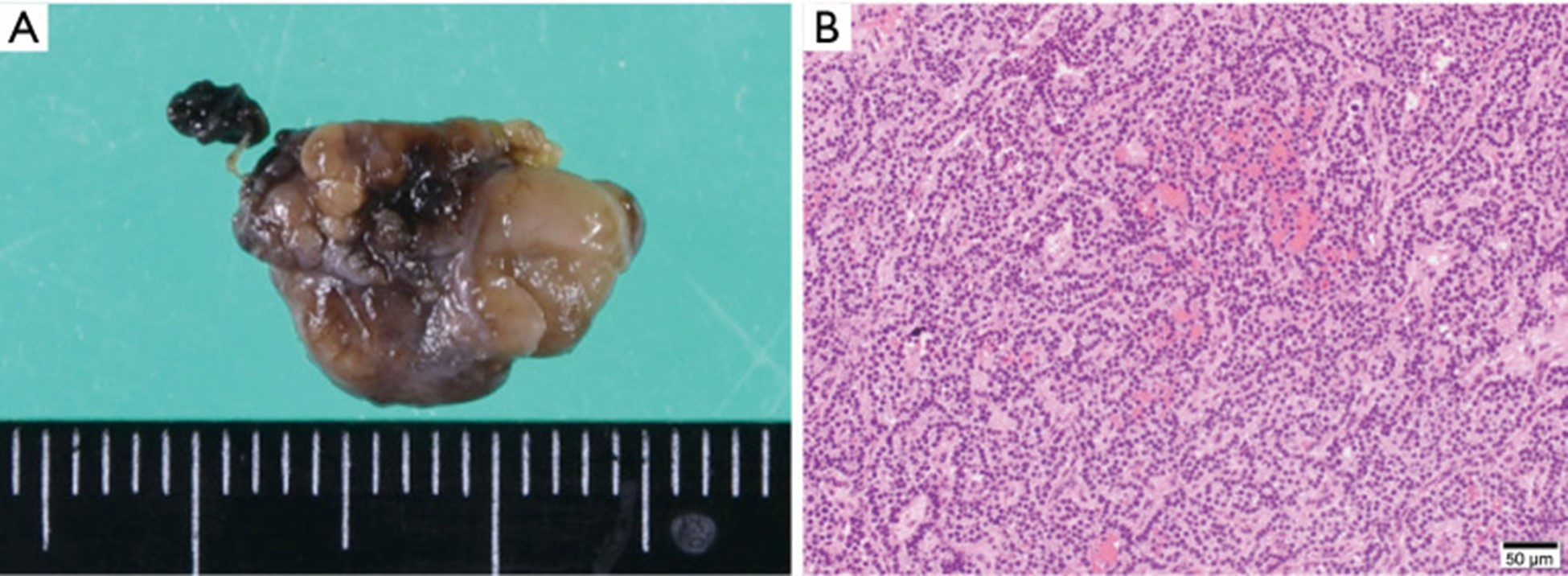 【佳学基因检测】原发性甲状旁腺功能亢进及钙代谢基因解码基因检测 【佳学基因检测】原发性甲状旁腺功能亢进及钙代谢基因解码基因检测