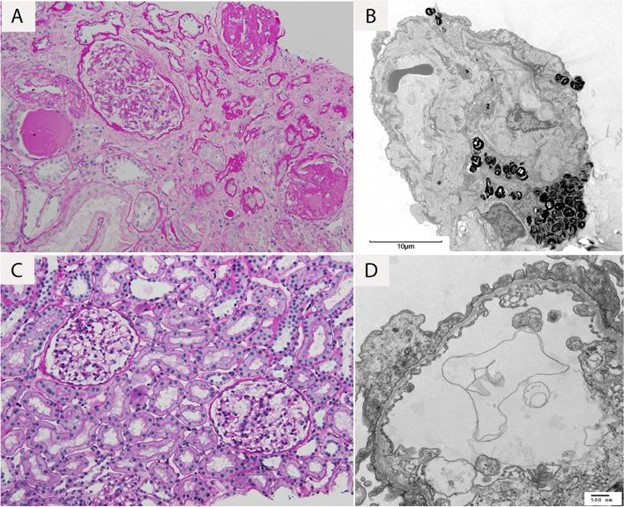 【佳学基因检测】遗传性肾脏疾病基因解码与基因检测：COL4A4突变及解释