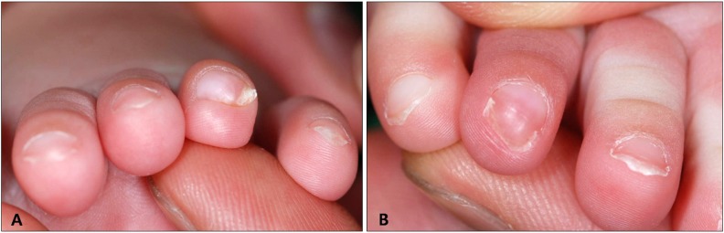【佳学基因检测】先天性第四脚趾趾甲的弯曲基因检测 【佳学基因检测】先天性第四脚趾趾甲的弯曲基因检测