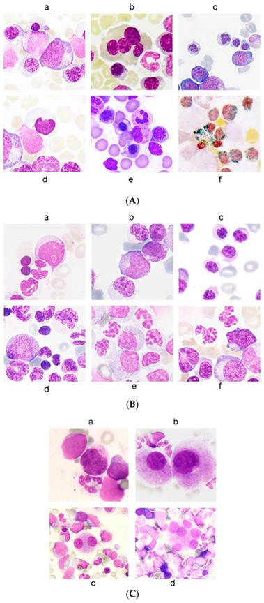 【佳学基因检测】骨髓增生异常综合征的基因解码与基因检测:诊断和筛查基础 【佳学基因检测】骨髓增生异常综合征的基因解码与基因检测:诊断和筛查基础