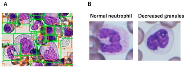 【佳学基因检测】骨髓增生异常综合征的基因解码与基因检测:诊断和筛查基础 【佳学基因检测】骨髓增生异常综合征的基因解码与基因检测:诊断和筛查基础